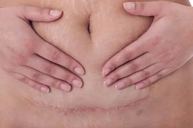 Ból brzucha po cesarce jak długo trwa i kiedy szukać pomocy