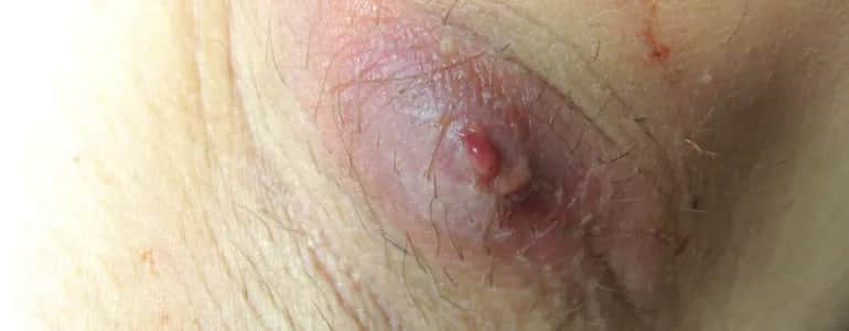 Czyrak do jakiego lekarza? Sprawdź, jak uniknąć powikłań.