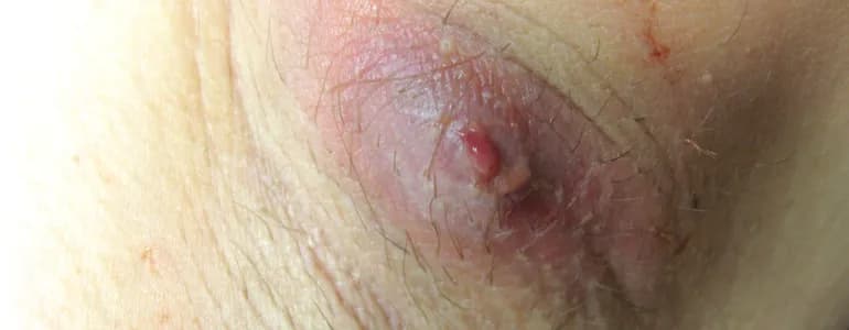 Czyrak do jakiego lekarza? Sprawdź, jak uniknąć powikłań.