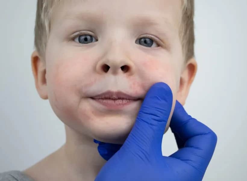 Podwyższony poziom limfocytów u dziecka - co powinno zaniepokoić rodziców?